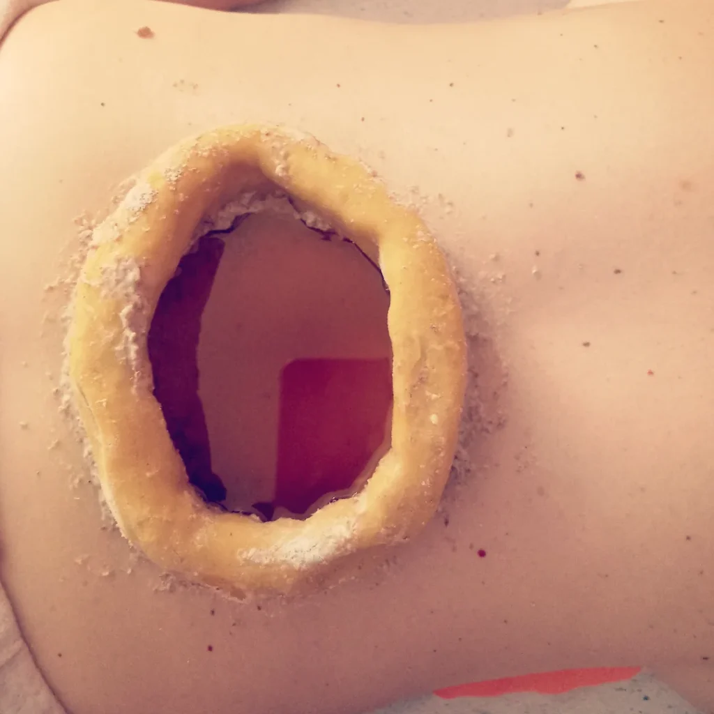 Endometriosi e rimedi naturali